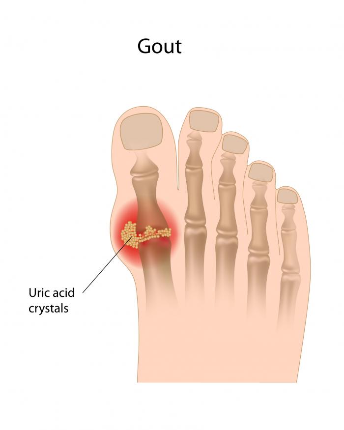 Gout Fotolia_45335859_L