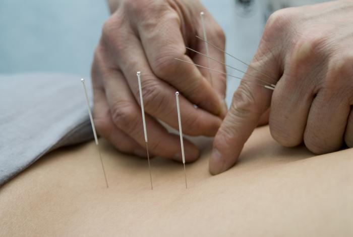 acupuncture